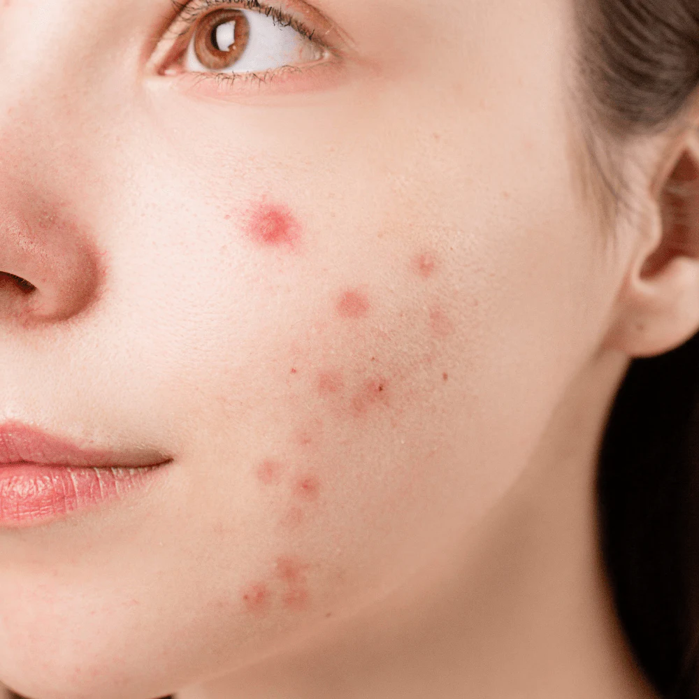Beleznay Skincare Clinic Beleznay Évi Kozmetikus - Aknék, pattanások és mitesszerek egy fiatal lány bőrén