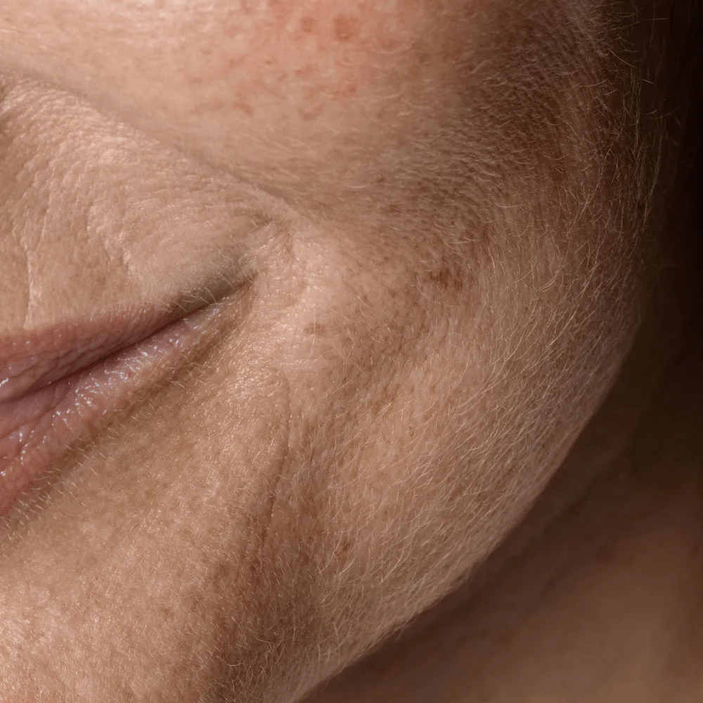 Beleznay Skincare Clinic Beleznay Évi Kozmetikus - Bőrszárazság, bőrhámlás, dehidratáció​