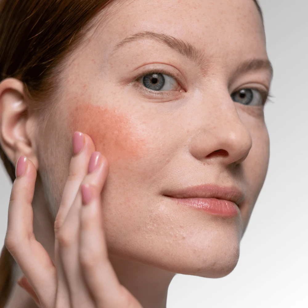 Beleznay Skincare Clinic Beleznay Évi Kozmetikus - Bőrirritáció, piros bőr