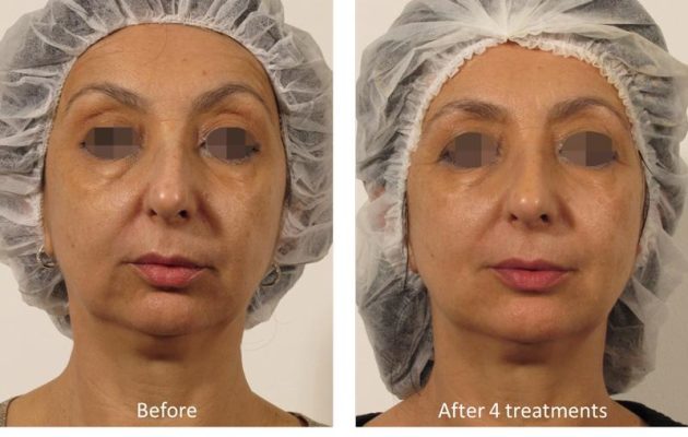 before-and-after-oxygeneo-8