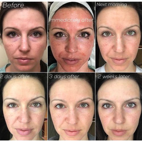 Germaine de Capuccini Dermatech pen tűs mezoterápia kezelés előtt és után