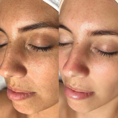 oxygen-facial-treatment